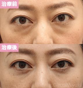 モニター症例№193（45歳 女性）脱脂コンデンスリポ
