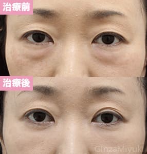 モニター症例№202（42歳 女性）脱脂コンデンスリポ
