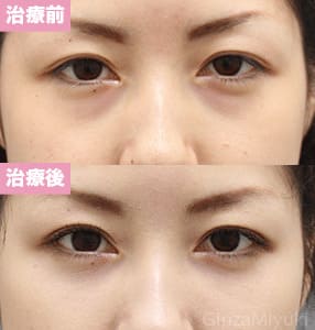 モニター症例№213（27歳 女性）脱脂コンデンスリポ