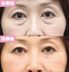 モニター症例№214（56歳 女性）脱脂コンデンスリポ