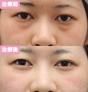 モニター症例№218（20歳 女性）脱脂コンデンスリポ