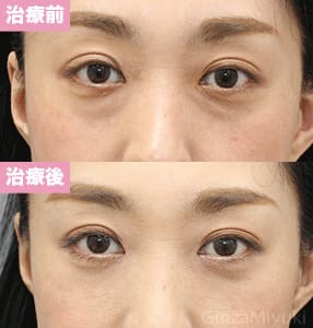 モニター症例№222（32歳 女性）脱脂コンデンスリポ
