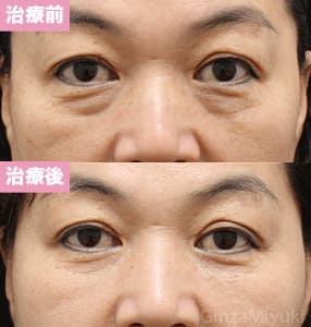 モニター症例№224（53歳 女性）脱脂コンデンスリポ