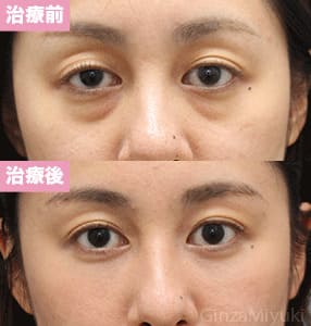 モニター症例№235（29歳 女性）脱脂コンデンスリポ