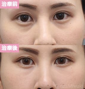 モニター症例№236（29歳 女性）脱脂コンデンスリポ