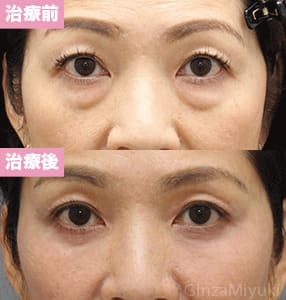モニター症例№244（49歳 女性）脱脂コンデンスリポ