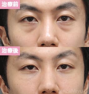モニター症例№249（29歳 男性）脱脂コンデンスリポ