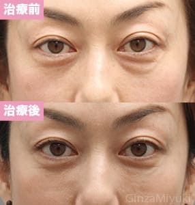 モニター症例№257（44歳 女性）脱脂コンデンスリポ