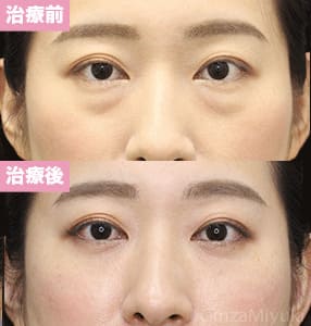 モニター症例№273（36歳 女性）脱脂コンデンスリポ