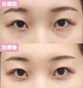 モニター症例№277（23歳 女性）脱脂コンデンスリポ