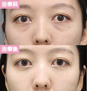 モニター症例№283（24歳 女性）脱脂コンデンスリポ