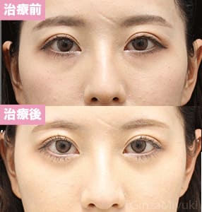 モニター症例№292（24歳 女性）経結膜脱脂