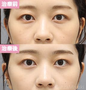 モニター症例№301（28歳 女性）経結膜脱脂