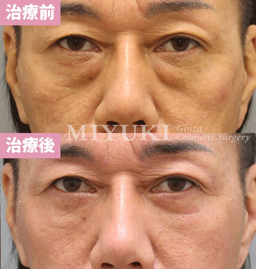 モニター症例№318（56歳 男性）脱脂コンデンスリポ