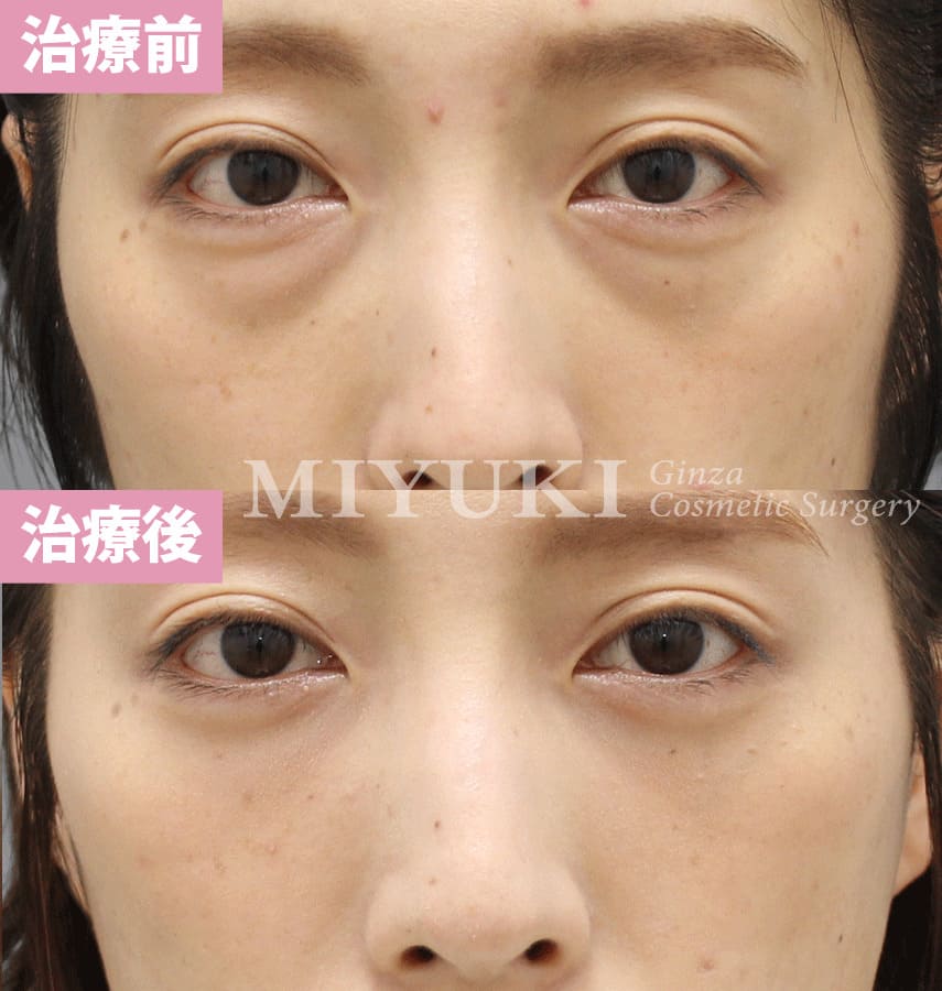 モニター症例№321（30歳 女性）脱脂コンデンスリポ