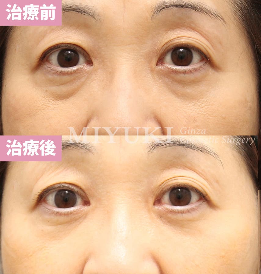 モニター症例№325（56歳 女性）脱脂コンデンスリポ