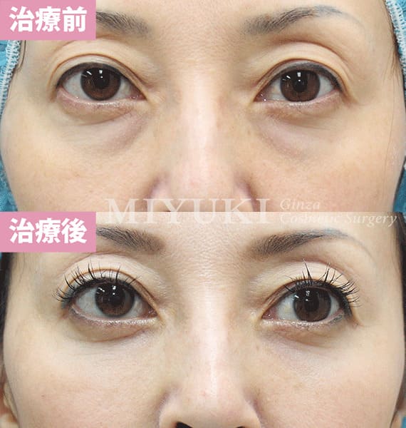 モニター症例№334（45歳 女性）脱脂コンデンスリポ