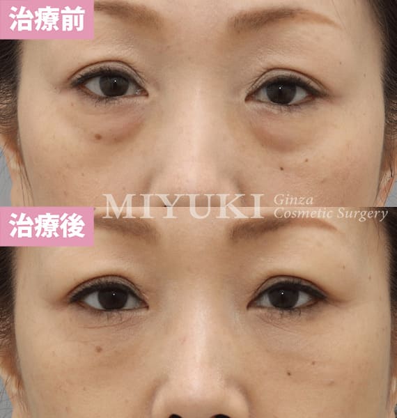 モニター症例№341（48歳 女性）脱脂コンデンスリポ