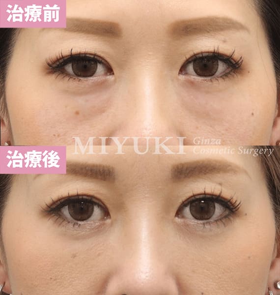 モニター症例№345（41歳 女性）脱脂コンデンスリポ