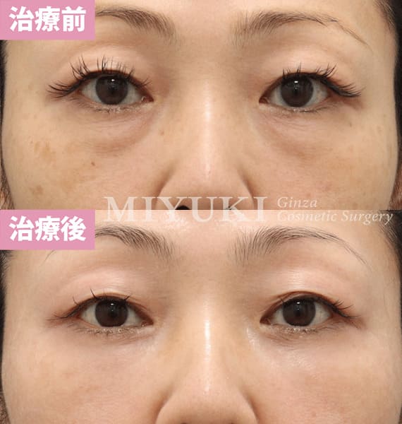 モニター症例№350（48歳 女性）脱脂コンデンスリポ