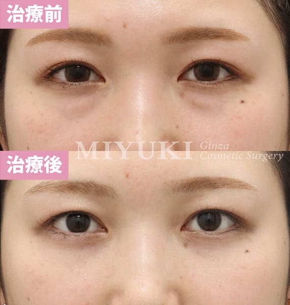 モニター症例№352（24歳 女性）脱脂コンデンスリポ