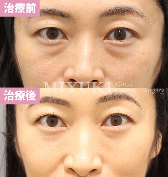 モニター症例№363（42歳 女性）脱脂コンデンスリポ