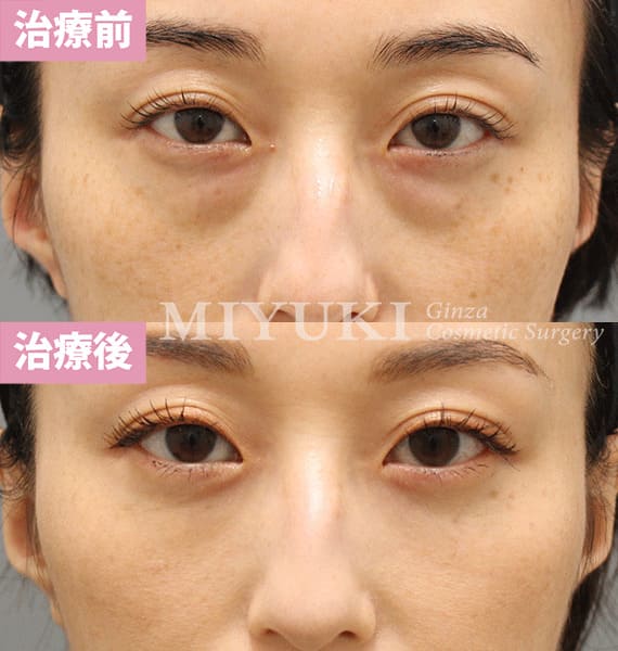 モニター症例№366（36歳 女性）脱脂コンデンスリポ