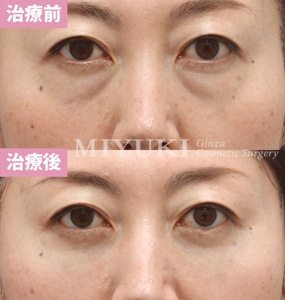 モニター症例№384（50歳 女性）脱脂コンデンスリポ