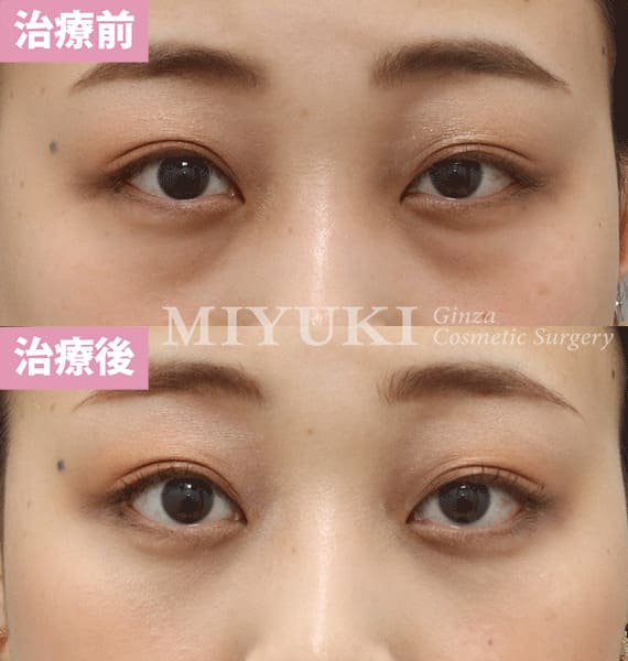 モニター症例№388（22歳 女性）脱脂コンデンスリポ