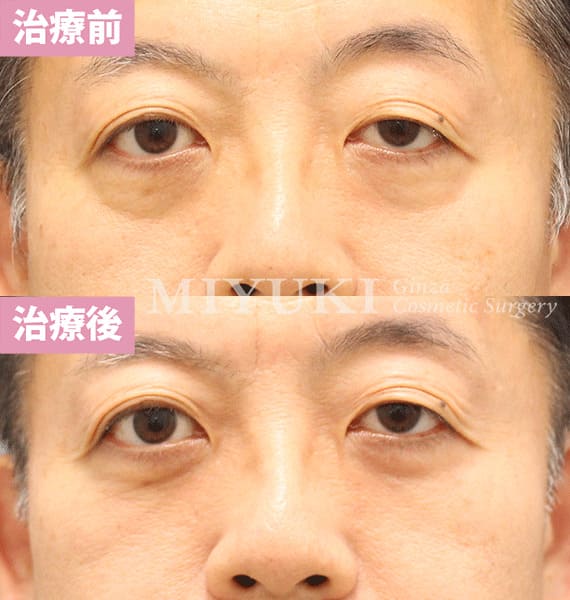 モニター症例№400（57歳 男性）脱脂コンデンスリポ