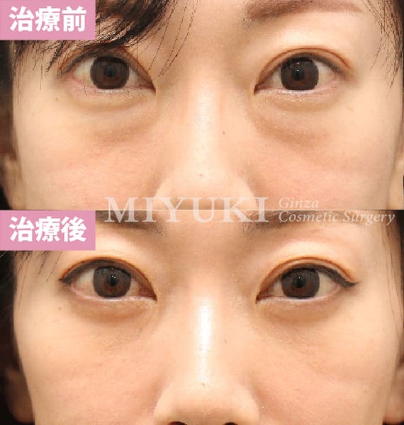 モニター症例№409（40歳 女性）脱脂コンデンスリポ