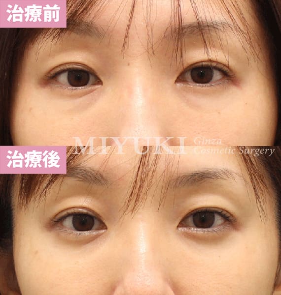 モニター症例№420（43歳 女性）脱脂コンデンスリポ