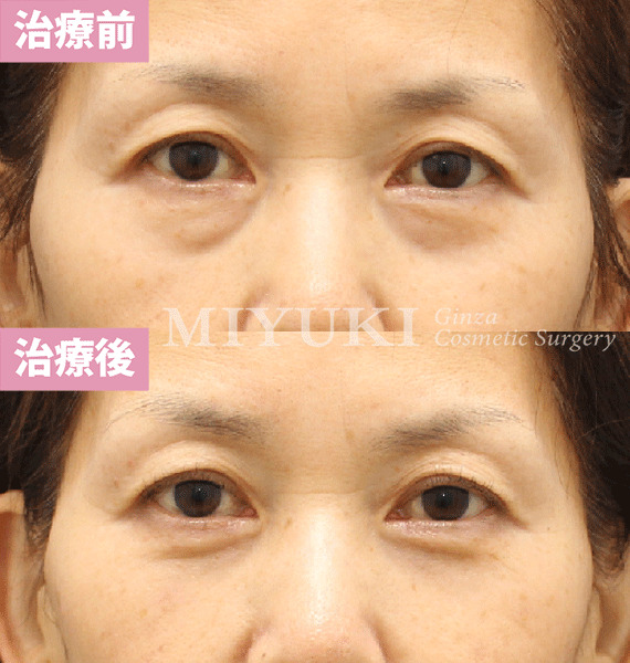 モニター症例№429（63歳 女性）脱脂コンデンスリポ