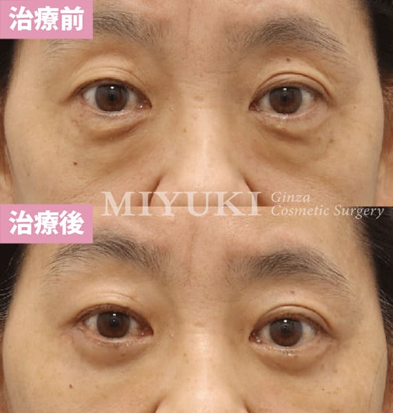 モニター症例№430（58歳 女性）脱脂コンデンスリポ＋表（切開）ハムラ法