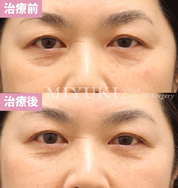 モニター症例№439（53歳 女性）脱脂コンデンスリポ