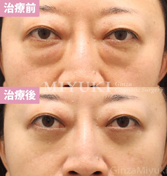 モニター症例№450（47歳 女性）脱脂コンデンスリポ