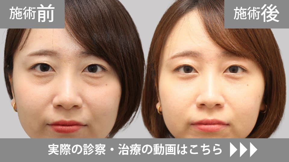 目の下のくま・たるみ取りモニター症例動画№04