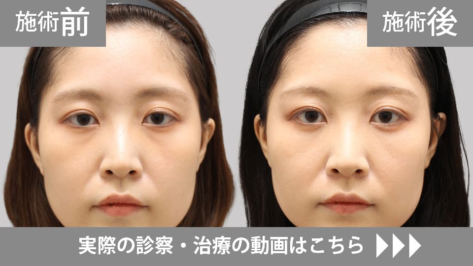 目の下のくま・たるみ取りモニター症例動画№07