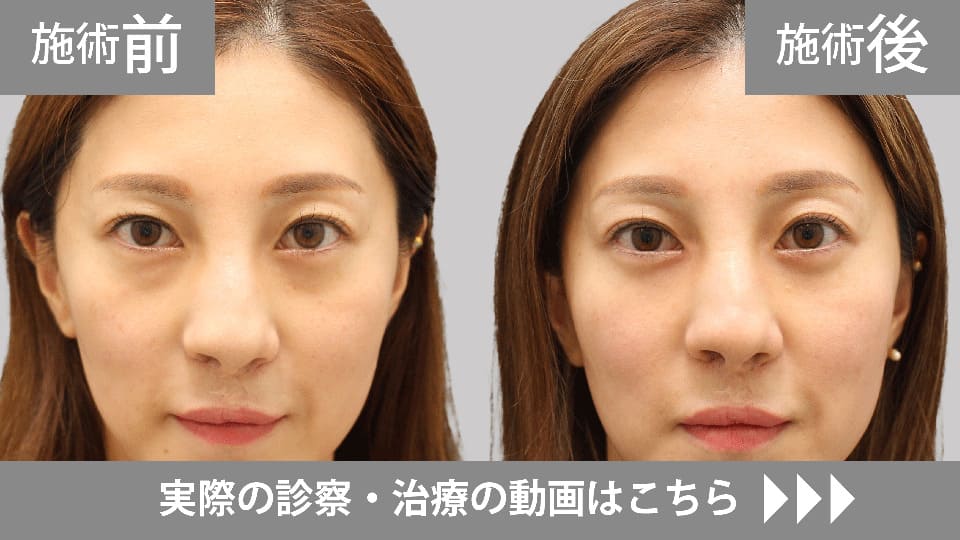 目の下のくま・たるみ取りモニター症例動画№08