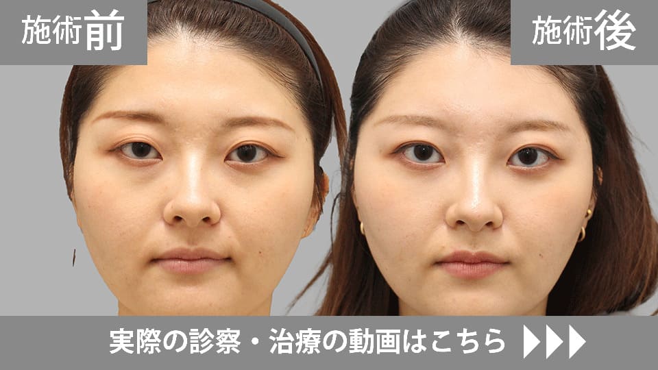 目の下のくま・たるみ取りモニター症例動画№18