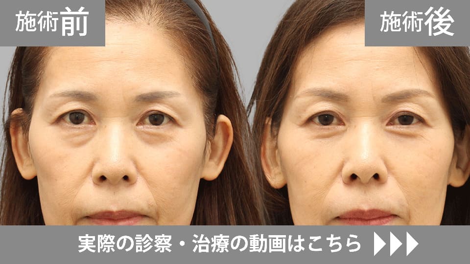 目の下のくま・たるみ取りモニター症例動画№20