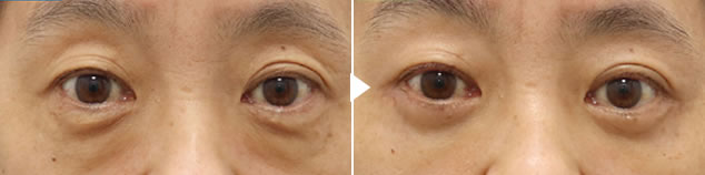 ハムラ法（表ハムラ法）