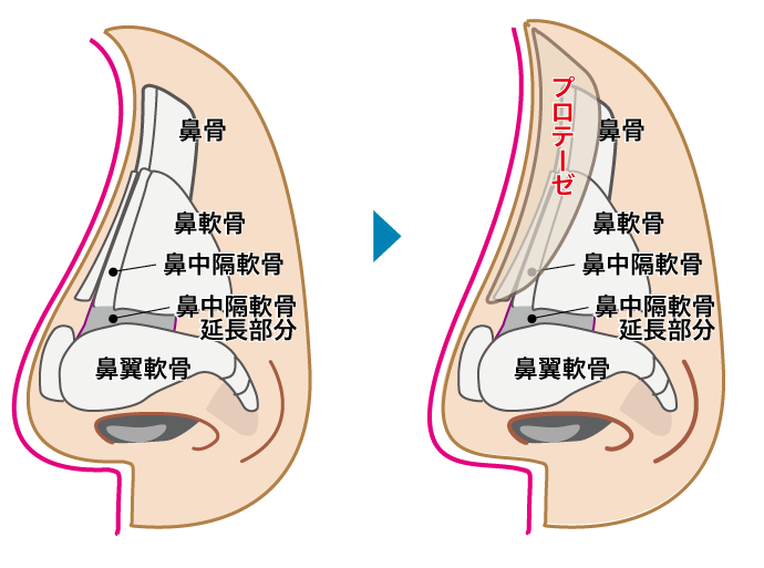 鼻中隔延長とプロテーゼ隆鼻術