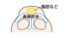 団子鼻イメージ