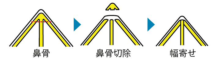 手術手順イラスト