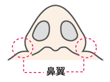 小鼻縮小術とは