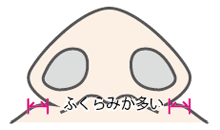 内側切除法