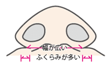 内側切除法フラップ固定法