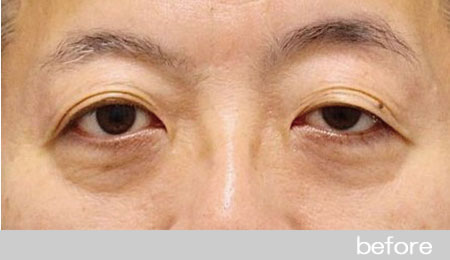 眼瞼下垂の症例３眼瞼挙筋前転法、目の下のクマ取り手術の術前