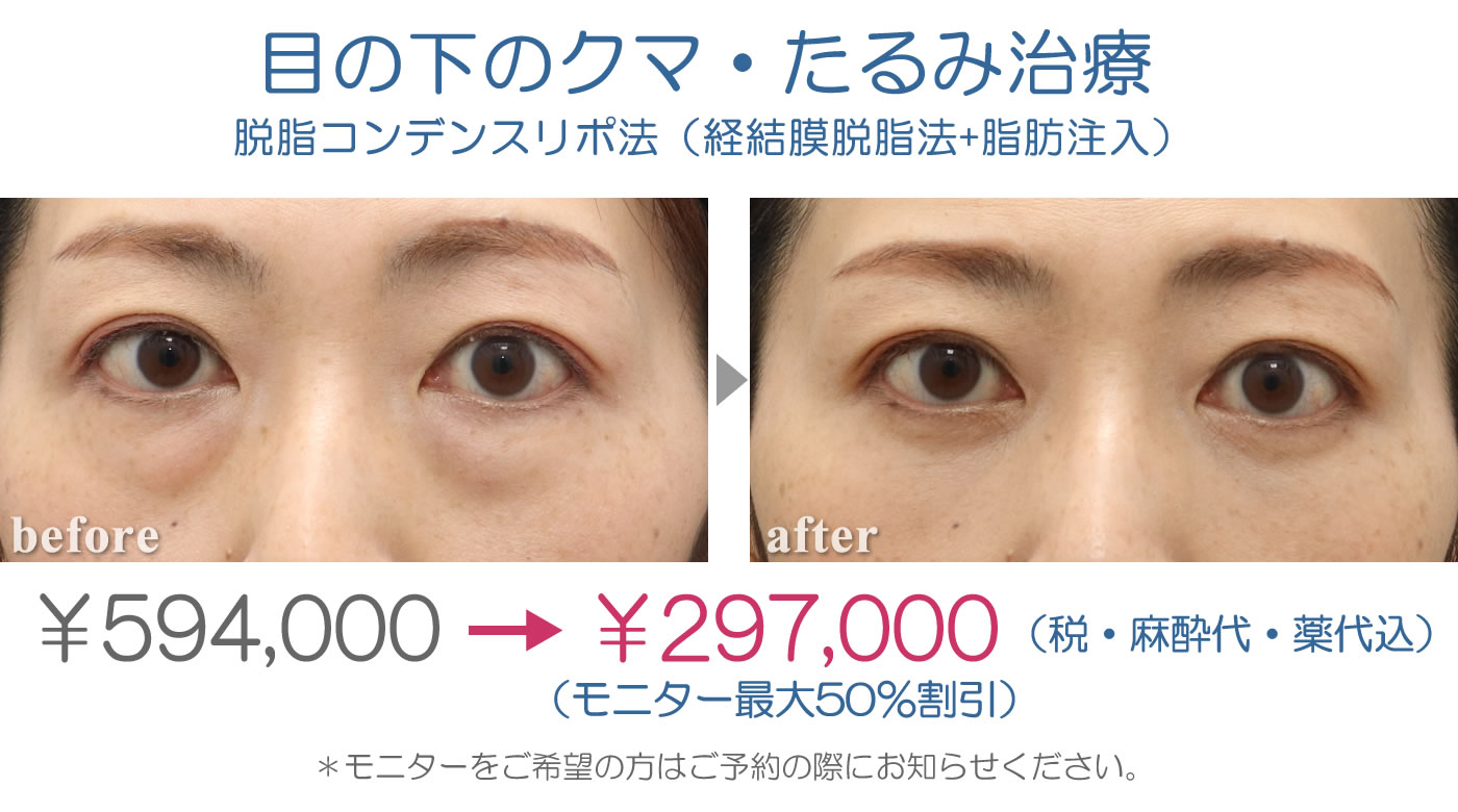 脱脂コンデンスリポ297,000円全て込み（モニター最大50％割引